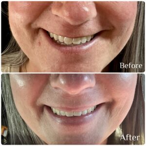 Before and after Daxxify lip flip treatment results at Contour & Sculpt Aesthetics for Round Rock TX patients
