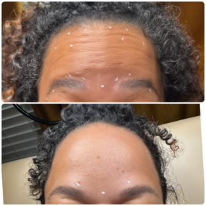 Before and after Letybo forehead wrinkle treatment for a patient at Contour & Sculpt Aesthetics in Austin, TX