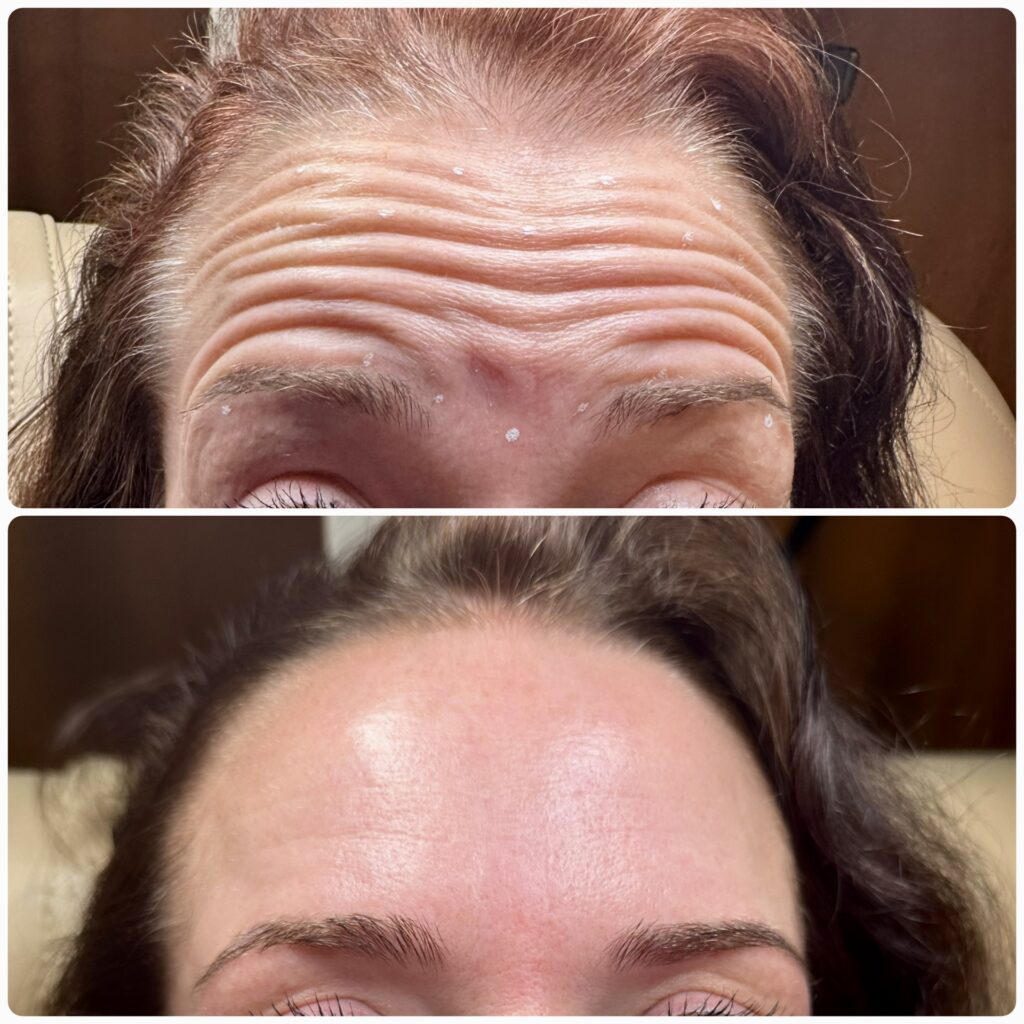 botox