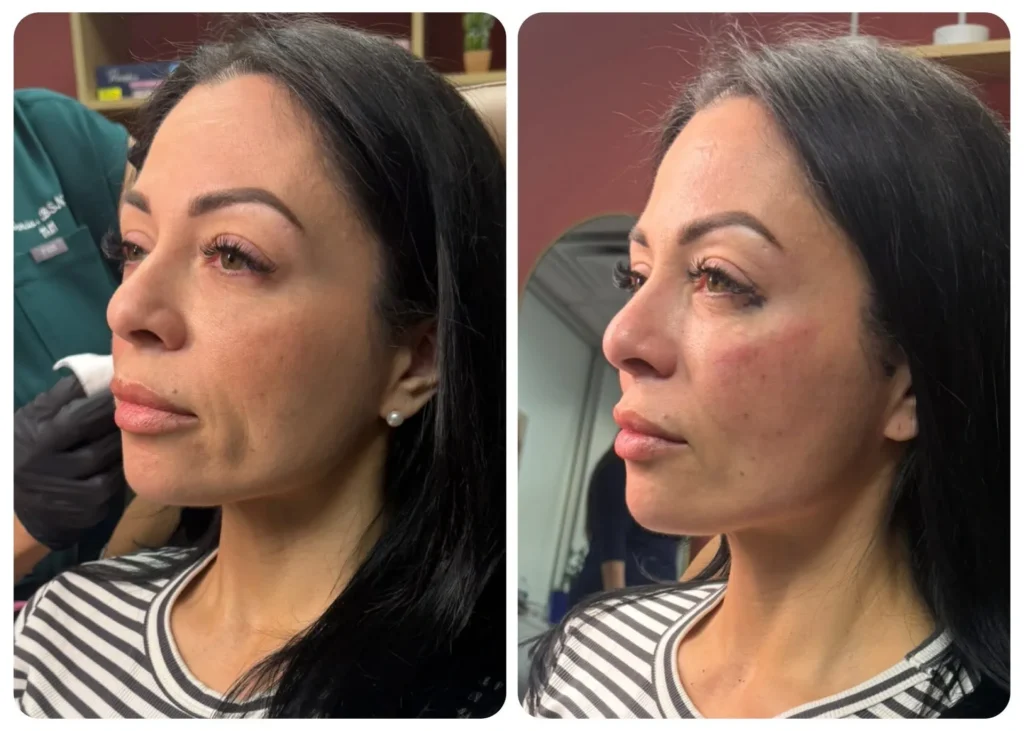 Microneedling in Leander TX: Your Guide to Radiant Skin